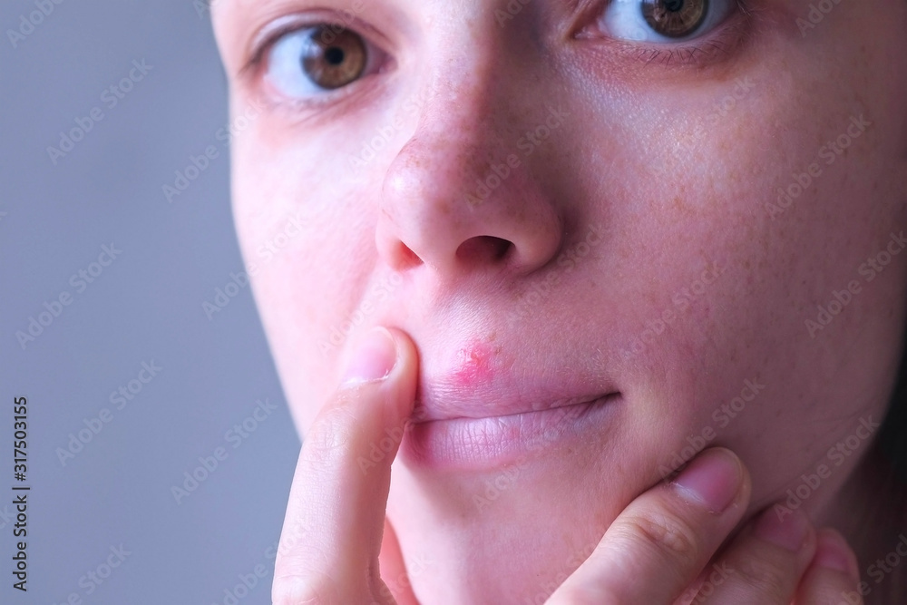 Herpes virus on human lips. Woman with herpes sore on upper lip on mouth, face closeup. Herpes Simplex Virus. Process of dehydration during illness. Human papilloma virus, viral infection. Herpes virus on human lips. Woman with herpes sore on upper lip on mouth, face closeup. Herpes Simplex Virus. Process of dehydration during illness. Human papilloma virus, viral infection.