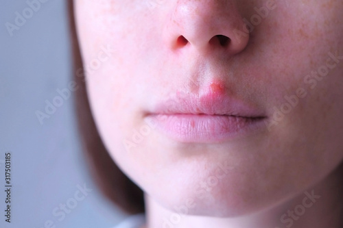 Herpes virus on human lips. Woman with herpes sore on upper lip on mouth, closeup front view. Process of dehydration during illness. Human papilloma virus, viral infection.