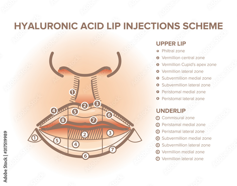 Lip injections. Lip anatomy poster. Hyaluronic acid filler Stock Vector