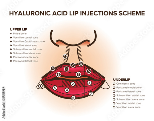 Lip injections. Hyaluronic acid filler. Lip anatomy