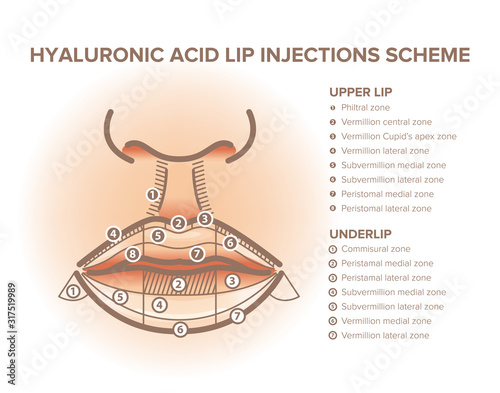 Lip injections. Lip anatomy poster. Hyaluronic acid filler
