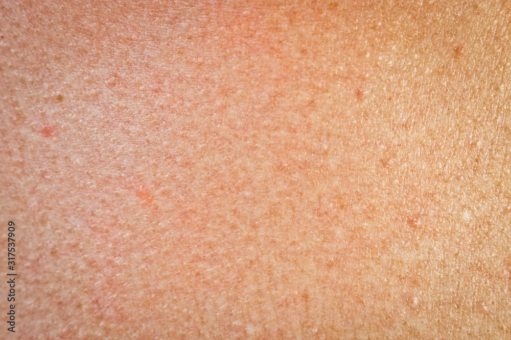 The texture of human skin with freckles and age spots. The texture of human skin with freckles and age spots.