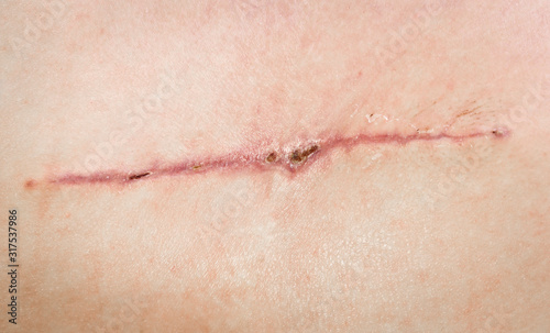 A seam after surgery on the skin of a person   s back. Surgical transplantation of a muscle flap from the back. Stitched wound self-absorbable threads  closeup. Scabs on a healing wound.