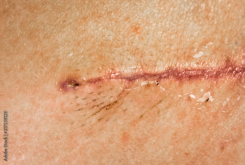 A seam after surgery on the skin of a person’s back. Surgical transplantation of a muscle flap from the back. Stitched wound self-absorbable threads, closeup. Scabs on a healing wound.