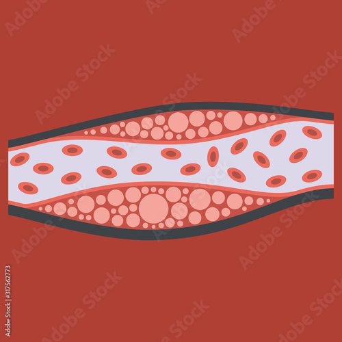Flat vienna human atherosclerosis.the structure of a veins . the veins in the manifestation of the disease