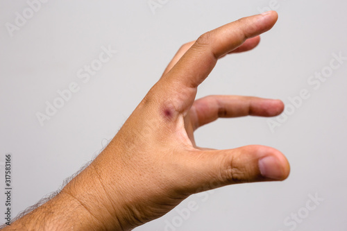 photo of a scorpion sting in a person's hand. Scorpion sting, danger scorpion poison.