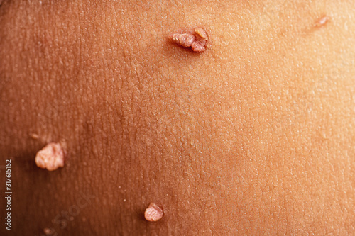 Skin tag or acrochordon or soft fibroma or mole in male armpit, macro photo. Papilloma virus or bump, dermatology problem on skin concept. photo