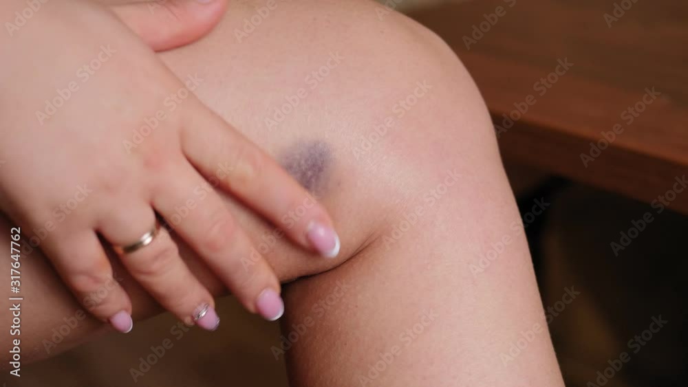 Close-up of a large bruise on a young woman's leg. A woman touches a large hematoma on her leg with her fingers. Domestic violence. Close-up of a large bruise on a young woman's leg. A woman touches a large hematoma on her leg with her fingers. Domestic violence.