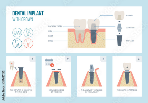 Dental implant medical procedure and structure