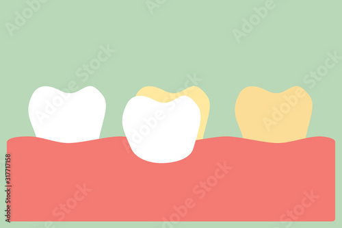 dental veneers installation procedure for tooth whiten - teeth cartoon vector flat style