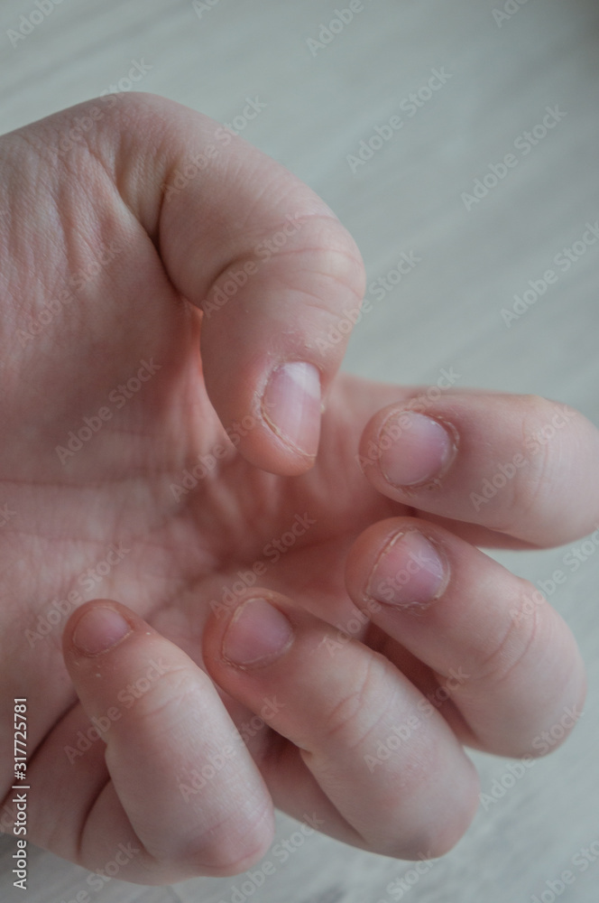 Bitten fingernails damaged due to anxiety disorders with damaged