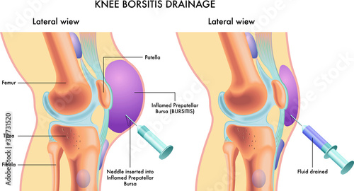 Labelled medical illustration showing knee bursitis drainage procedure.