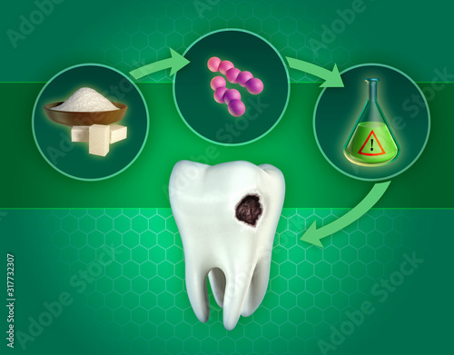 Formation of dental cavities photo