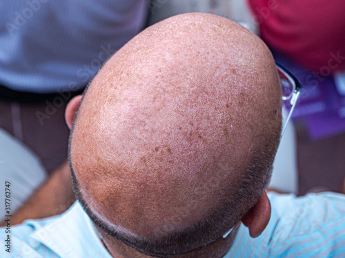 close up baldness from top of head