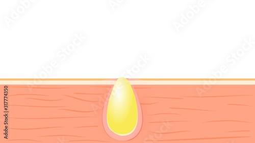 Formation of skin acne or pimple. The sebum in the clogged pore promotes the growth of a certain bacteria. This leads to the redness and inflammation associated with pimples photo