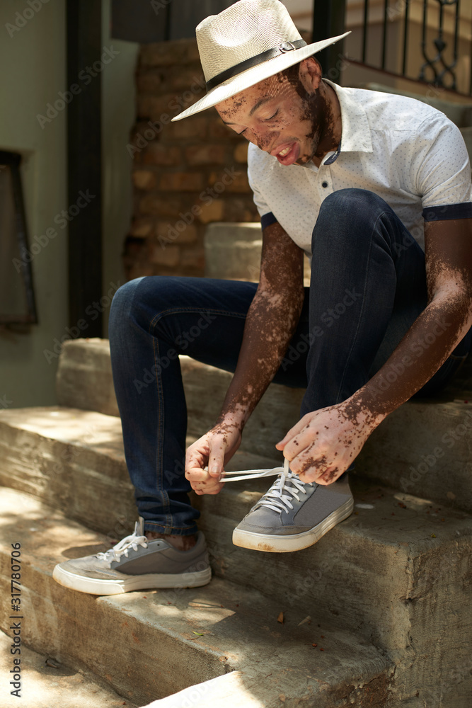 Portrait of young man with vitiligo wearing a hat, tying his shoes sitting on the stairs Portrait of young man with vitiligo wearing a hat, tying his shoes sitting on the stairs