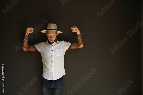 Portrait of young man with vitiligo wearing a hat on a black wall showing his spotted arms photo