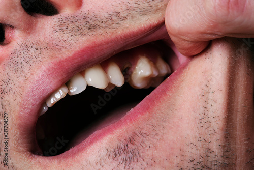 Man,showing mouth without tooth (broken) using fingers