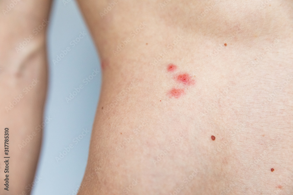 Herpes on body. Skin disease. Professional doctor examining skin of a patient. Herpes on body. Skin disease. Professional doctor examining skin of a patient.