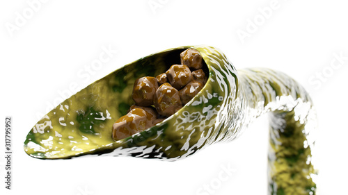 Gallstones blockage in gallbladder 3D render illustration