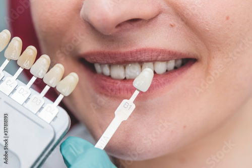 dentist using shade guide at beautiful smile of female mouth to check the process of teeth whitening or shades of the implants, dental health and teeth care concept