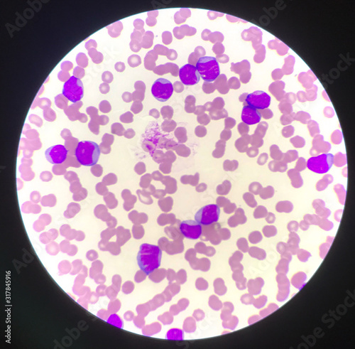 Immature cell or bast cell in leukemia patiens.