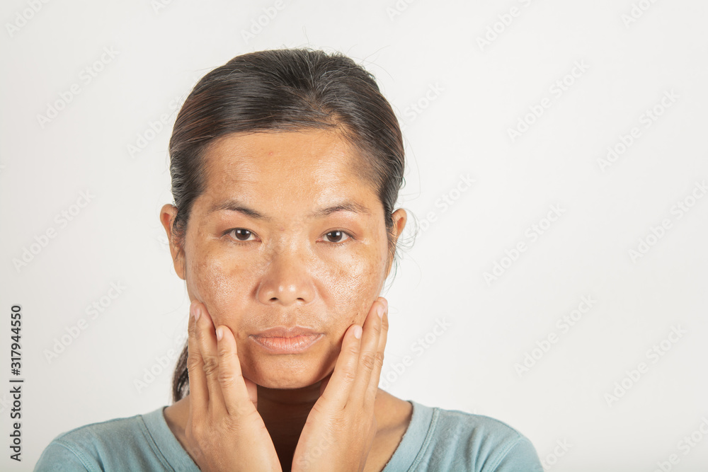 spot melasma dark and freckles facial treatment on face asian woman. and skin Problem spot melasma dark and freckles facial treatment on face asian woman. and skin Problem