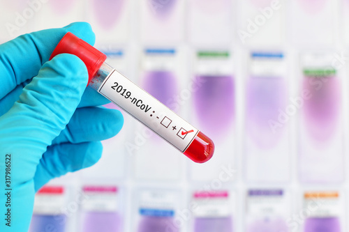 Blood sample tube positive with 2019-nCoV, novel coronavirus 2019 found in Wuhan, China photo