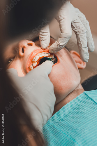 Εκτύπωση καμβά The boy with his mouth open lies in the dentist's chair while the orthodontist holds the plate on his teeth