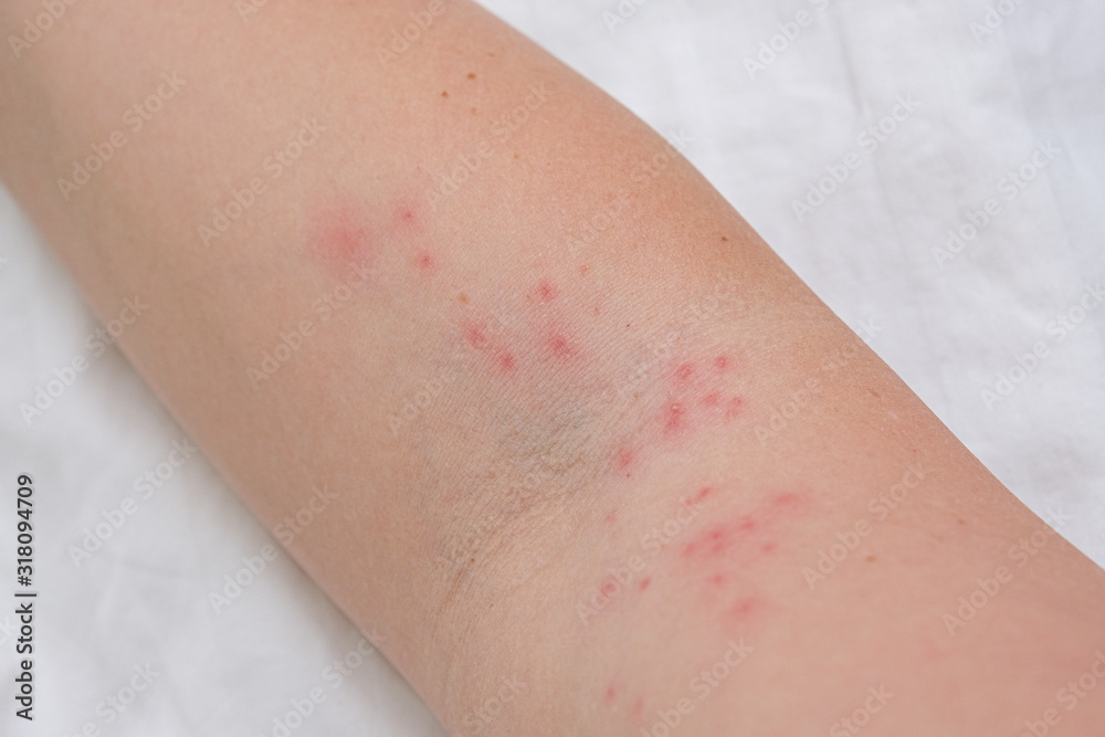 Fototapeta premium Skin rash on female arm, itchy pimples as a result of an allergic reaction, response, concept of allergy and dermatology