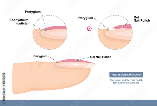 Pterygium and Gel Nail Polish. Nail Extension Mistakes. Professional Manicure Tutorial. Vector illustration photo