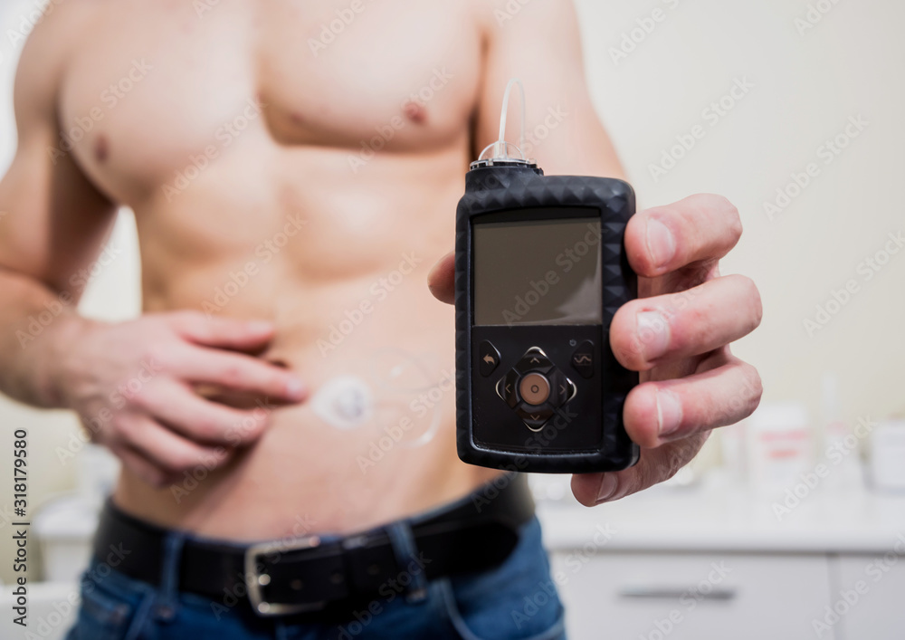 Diabetic man with an insulin pump connected in his abdomen Diabetic man with an insulin pump connected in his abdomen