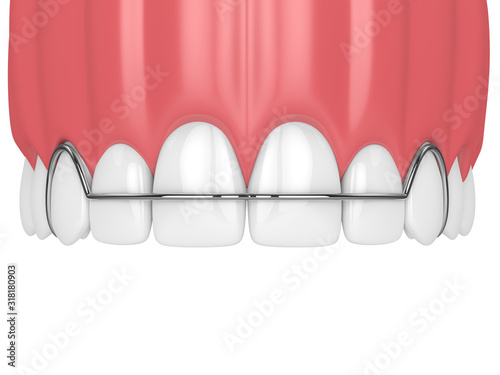 3d render of jaw with orthodontic removable retainer