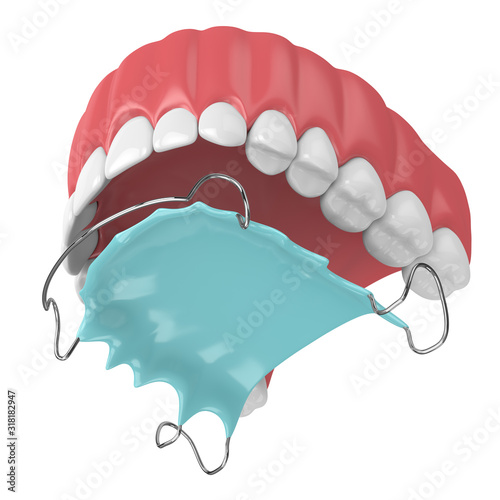 3d render of jaw with orthodontic removable retainer
