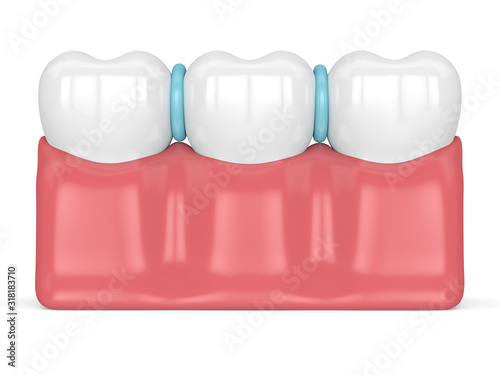 3d render of rubber separators between teeth