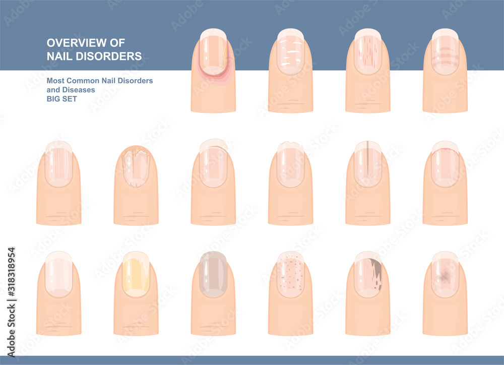 Most Common Nail Disorders and Diseases. Big set. Vector illustration