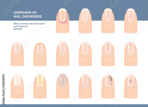 Most Common Nail Disorders and Diseases. Big set. Vector illustration