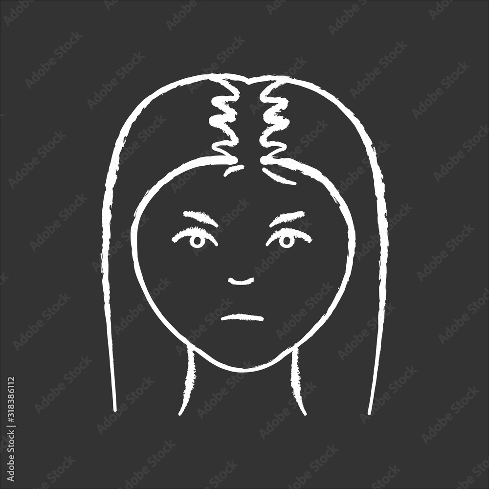 Female hair chalk white icon on black background. Woman with alopecia. Hairloss problem. Dermatology and beauty treatment. Thinning hairline. Falling hair. Isolated vector chalkboard illustration