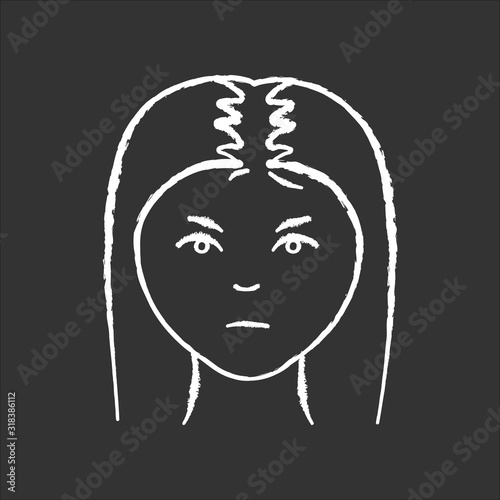 Female hair chalk white icon on black background. Woman with alopecia. Hairloss problem. Dermatology and beauty treatment. Thinning hairline. Falling hair. Isolated vector chalkboard illustration
