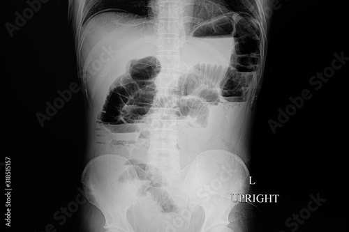 x-ray film of a patient with bowel obstruction. photo
