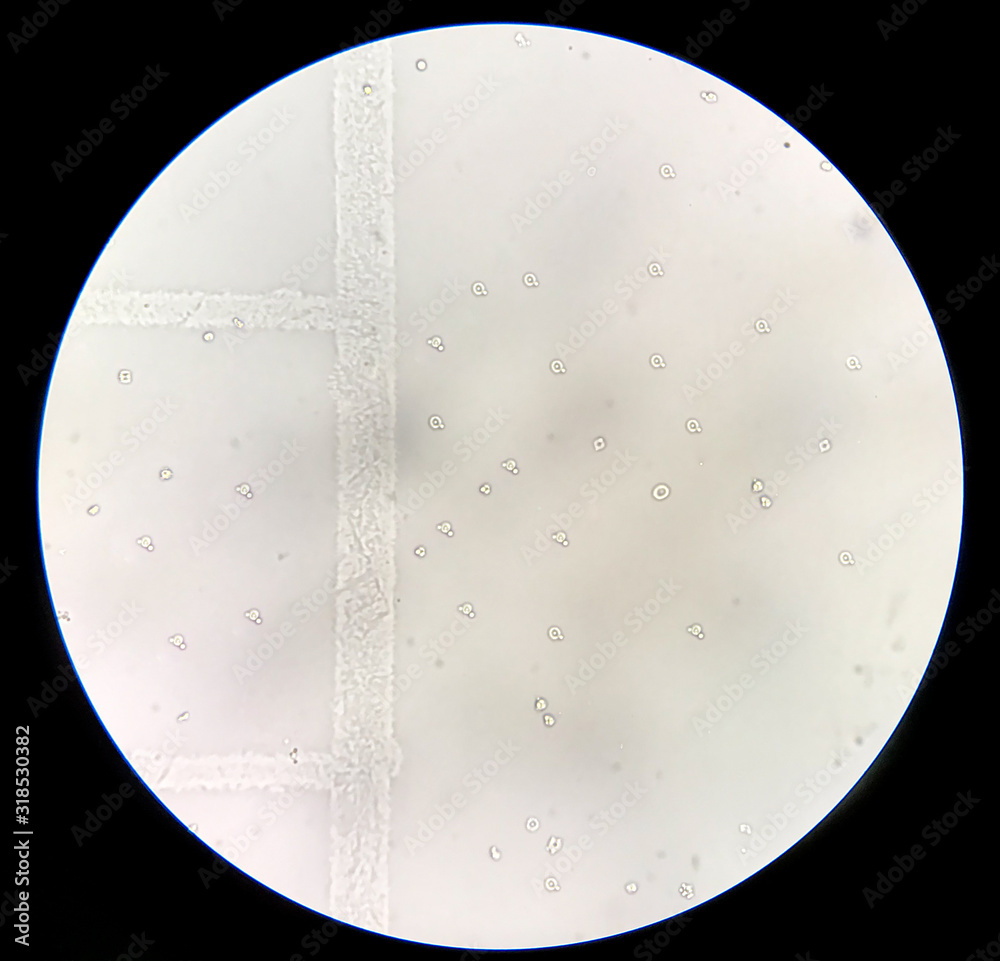 Dysmorphic red blood cells in urine sediment. Stock Photo Adobe Stock