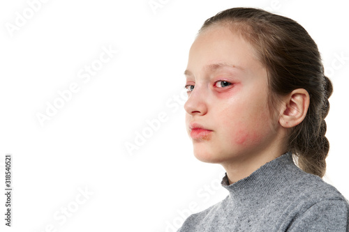 Allergic reaction, skin rash, close view portrait of a girl's face. Redness and inflammation of the skin in the eyes and lips. Immune system disease.