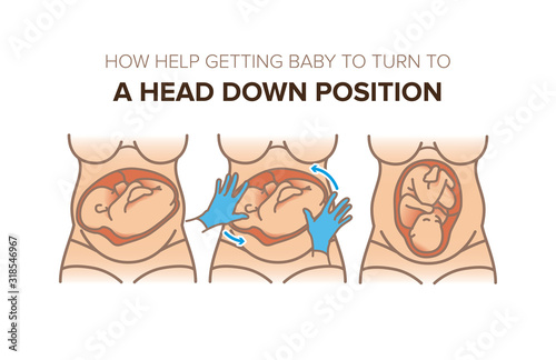 how help getting baby to turn to a head down position in the womb. Pregnancy