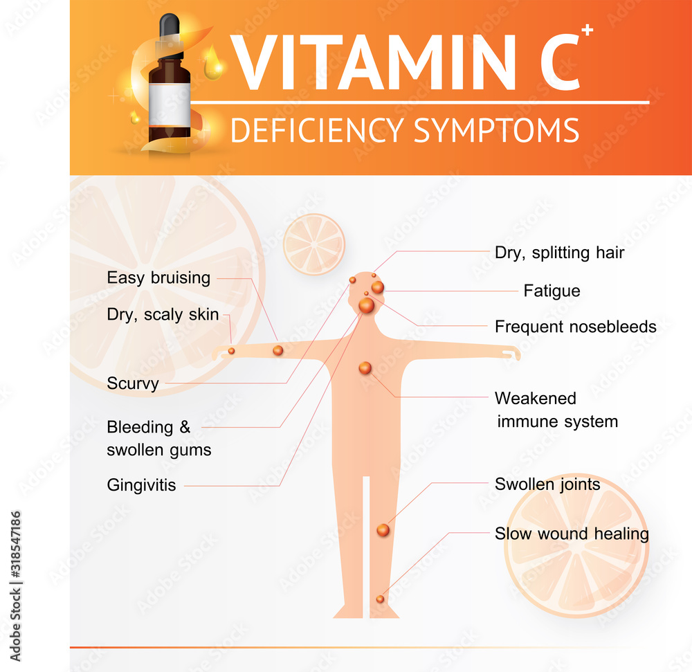 VITAMIN C DEFICIENCY SYMPTOMS INFOGRAPHIC HUMAN BODY. Stock Vector