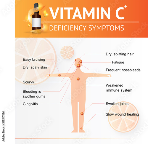 VITAMIN C DEFICIENCY SYMPTOMS INFOGRAPHIC HUMAN BODY.
