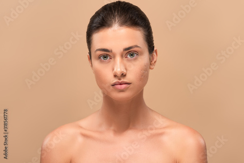 young naked woman with problem skin looking at camera isolated on beige © LIGHTFIELD STUDIOS