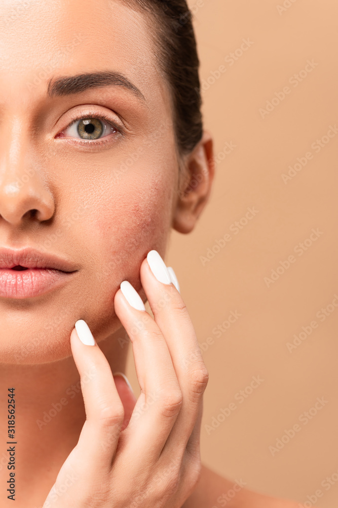 cropped view of girl touching face with problem skin and looking at camera isolated on beige cropped view of girl touching face with problem skin and looking at camera isolated on beige