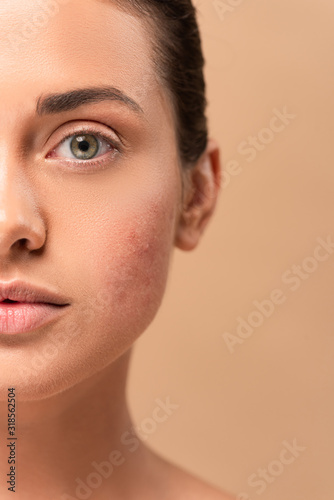 Cuadro en lienzo cropped view of girl with problem skin looking at camera isolated on beige