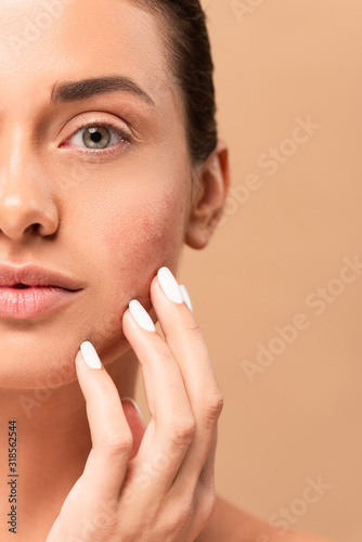cropped view of girl touching face with problem skin and looking at camera isolated on beige photo
