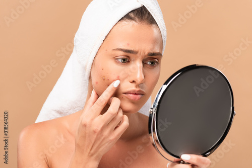 upset nude girl in towel touching acne on face and looking at mirror isolated on beige